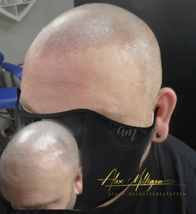 Before After scalp micropigmentation scalp tattoo bournemouth