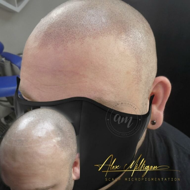Before After scalp micropigmentation scalp tattoo bournemouth