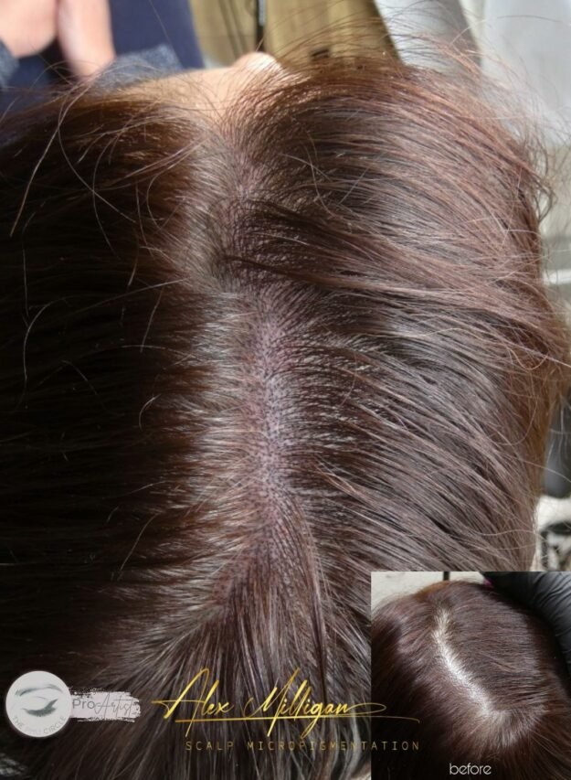 Hair Density Female Hairloss Scalp Tattoo Bournemouth