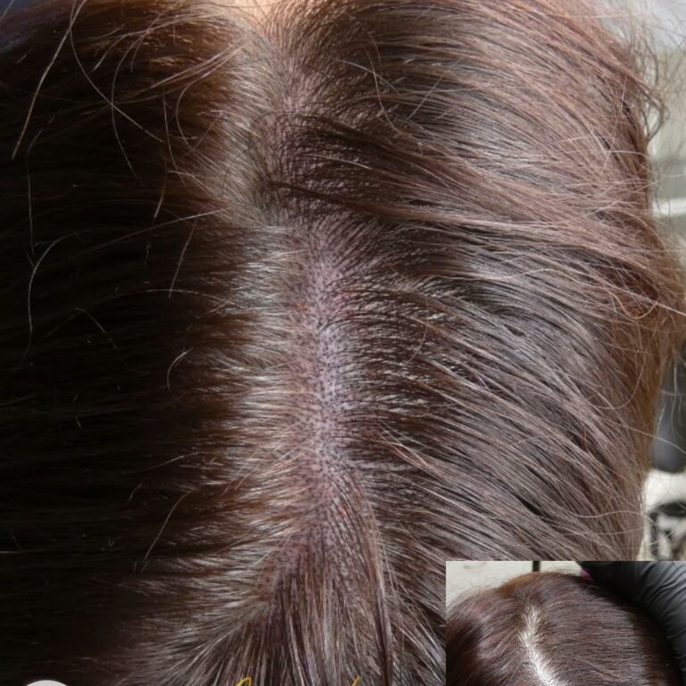 Hair Density Female Hairloss Scalp Tattoo Bournemouth