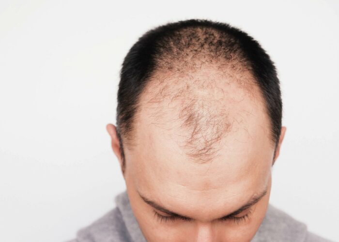 Male,Pattern,Hair,Loss,Problem,Concept.,Young,Man,Losing,Hair