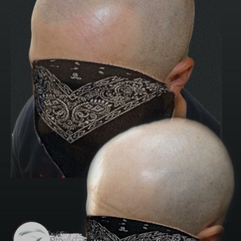 SCALP TATTOO - Alex Milligan SMP Bournemouth