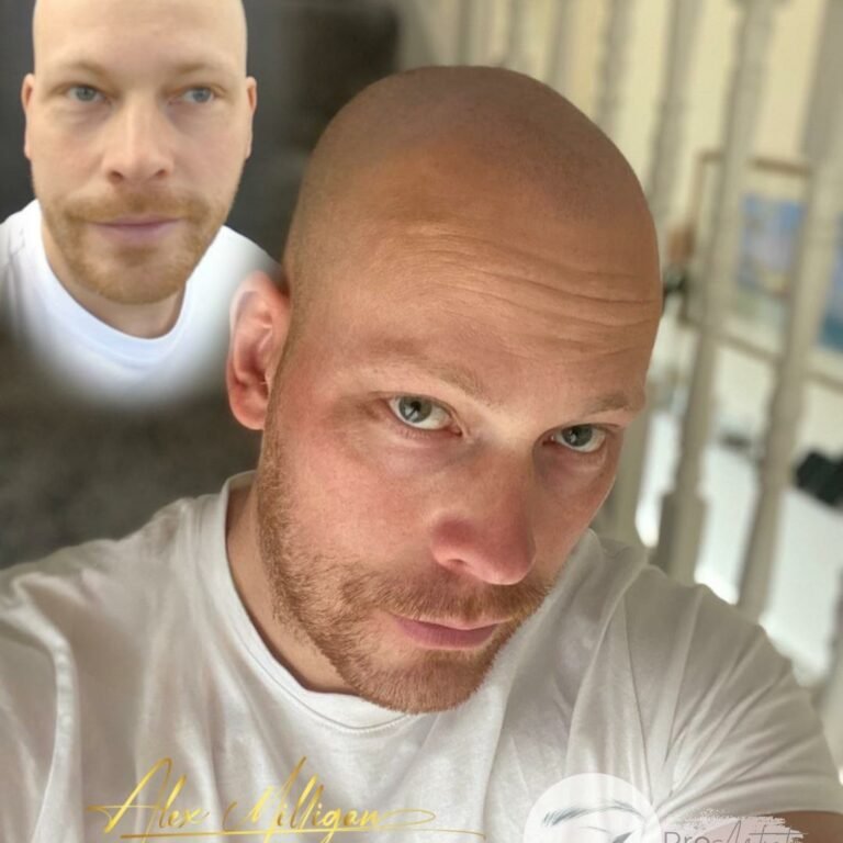 Scalp Tattoo Bournemouth - SMP scalp tattoo bournemouth before after