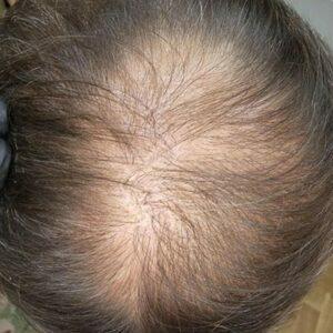 Scalp Micropigmentation Thin-Hair-1