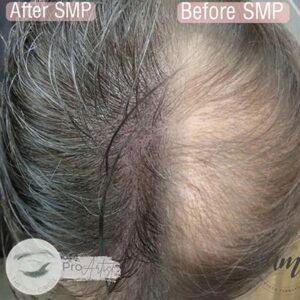 Scalp Micropigmentation Thin-Hair-2