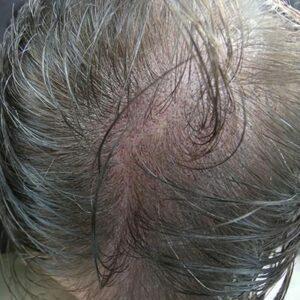 Scalp Micropigmentation Thin-Hair-3