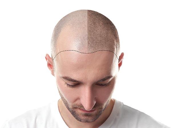 Scalp-Micropigmentation-treatments-before-and-after-by-Alex-Milligan