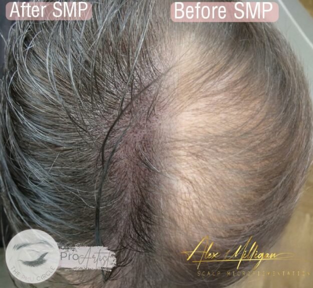Scalp Tattoo Bournemouth - hair Density SMP by Alex Milligan