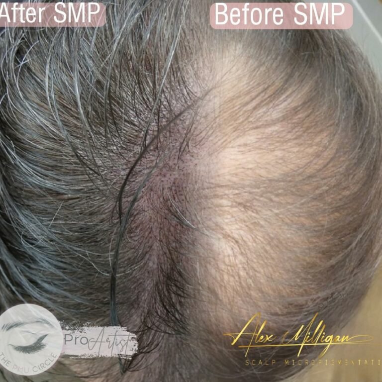 Scalp Tattoo Bournemouth - hair Density SMP by Alex Milligan