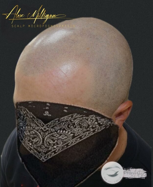 Scalp Tattoo Bournemouth - scalp tattoo smp